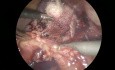 Retrograde Cholecystectomy in Patients with Liver Cirrhosis