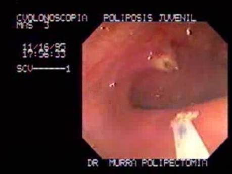 Non Familial Juvenile Polyposis Of The Colon (8 of 37)