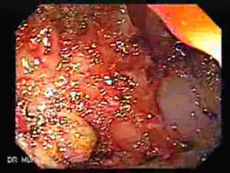 Toxic Dilatation Of The Colon Superimposed Pseudomembranous Colitis (2 z 17)
