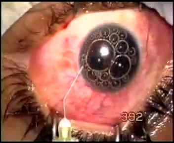Fugo Blade - singh filtration in a case of complicated crude trauma