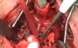 Trachea - Circular Resection 