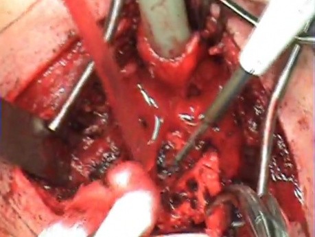 Trachea - Circular Resection 