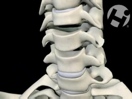 Anterior Cervical Discectomy with Fusion