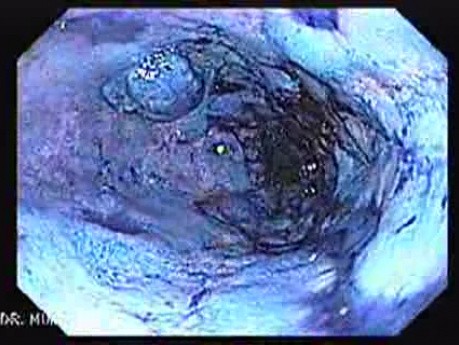 Chromoendoscopy Of The Esophagus - Reflux Esophagitis