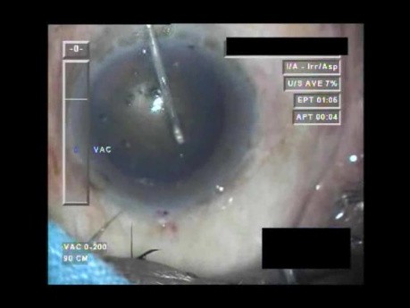 Cataract Surgery VII - Part 1