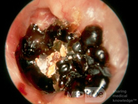 Inspissated Blood External Canal