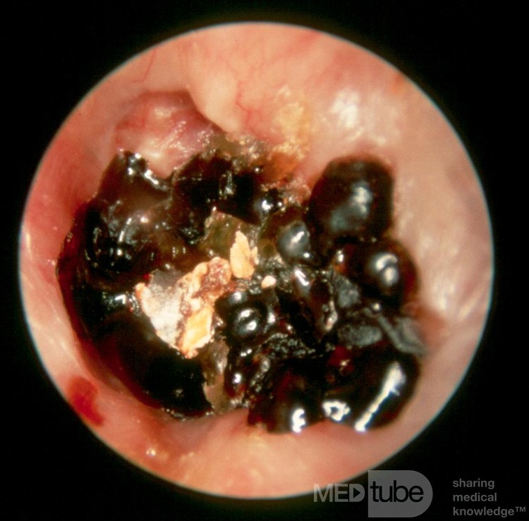 Inspissated Blood External Canal