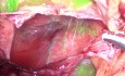 Use of ICG Fluorescence Guided Surgey During Laparoscopic Liver Cyst Fenestration