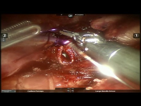 Carcinoid Tumor - Robotic Surgery