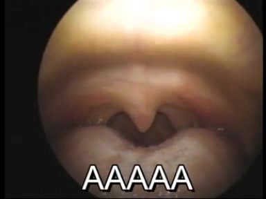 Difference in Palatal and Oropharyngeal Configuration upon Phonation of Vowels