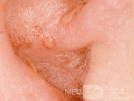 Herpes Zoster Pinna