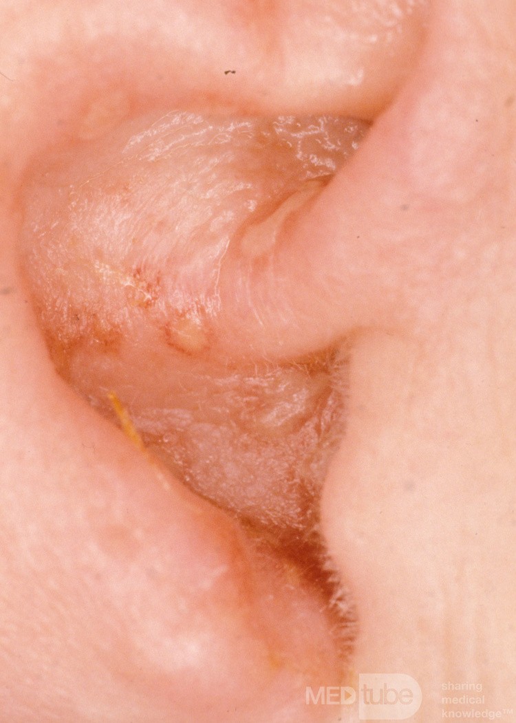 Herpes Zoster Pinna