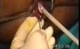 Cryosurgery Of Piles