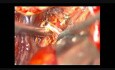 Brain aneurysm - Middle Cerebral Artery Bifurcation - Microsurgical Clipping