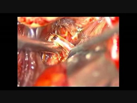 Brain aneurysm - Middle Cerebral Artery Bifurcation - Microsurgical Clipping