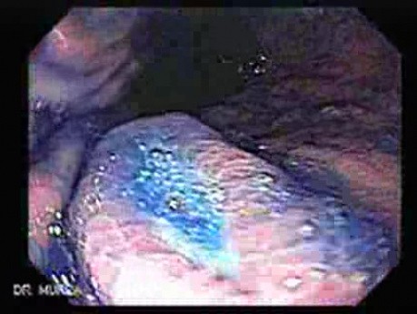 Multiple Gastric Ulcers - Endoscopy (6 of 10)