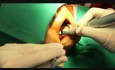Mandibular Implant Surgery – Sector 4