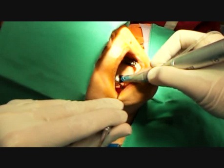 Implant Mandibular Surgery in Sector 4