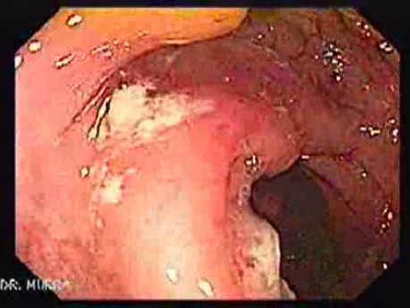 Colonic Tuberculosis Mimicking Crohn's Disease (4 of 12)