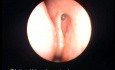 Successful endoscopic dacrocystorhinostomy - postoperative view