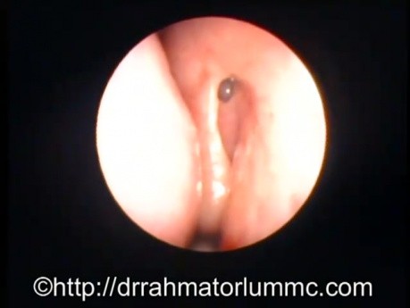 Successful endoscopic dacrocystorhinostomy - postoperative view
