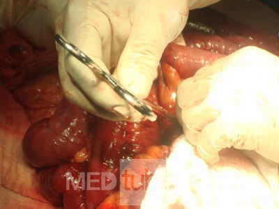 Mesenteric Ischemia (8 of 12)