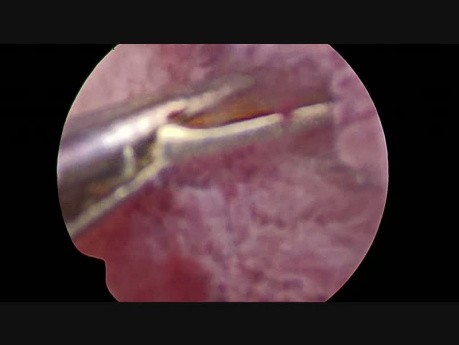 Hysteroscopic Polypectomy
