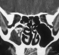 Fungal Sinusitis [CT Scan]