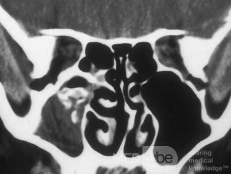 Fungal Sinusitis [CT Scan]