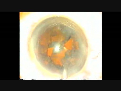Posterior Polar Cataract with PC Rent