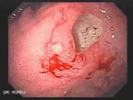 Gastric Ulcer - Endoscopy (2 of 3)