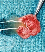 Mucocele of the Lip [surgical specimen opened]