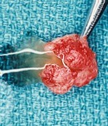 Mucocele of the Lip [surgical specimen opened]
