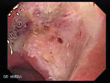 Duodenal Ulcer and Bleeding (14 of 23)