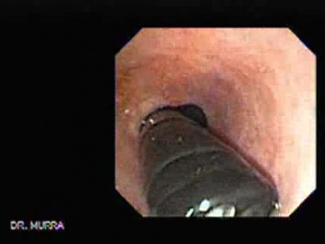 The Upper Gastrointestinal Tract - Video Endoscopic Sequence (1 of 6)