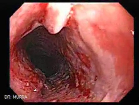 Esophageal Squamous Cell Carcinoma (1 of 2)