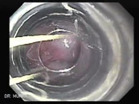 Severe Bleeding of the Upper Digestive System After Two Days of Band Ligation - A Case of 57 Years-Old Alcoholic Male