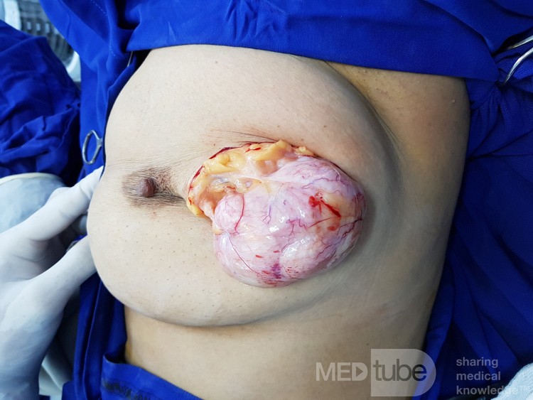 Giant Fibroadenoma