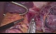 Stomach Fundus GIST Laparoscopic Resection