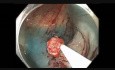 Colonoscopy Channel Quiz 8