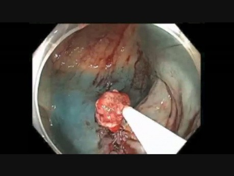 Colonoscopy Channel Quiz 8