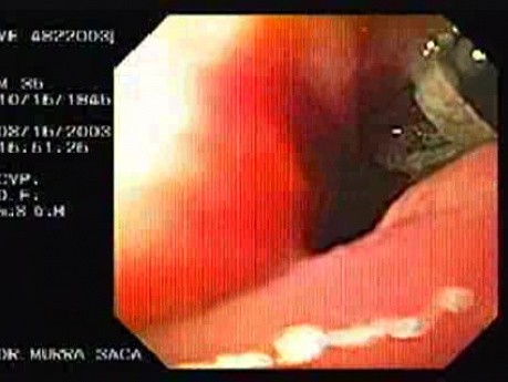 Flexible Endoscopic Suturing - Preparing the Sutures