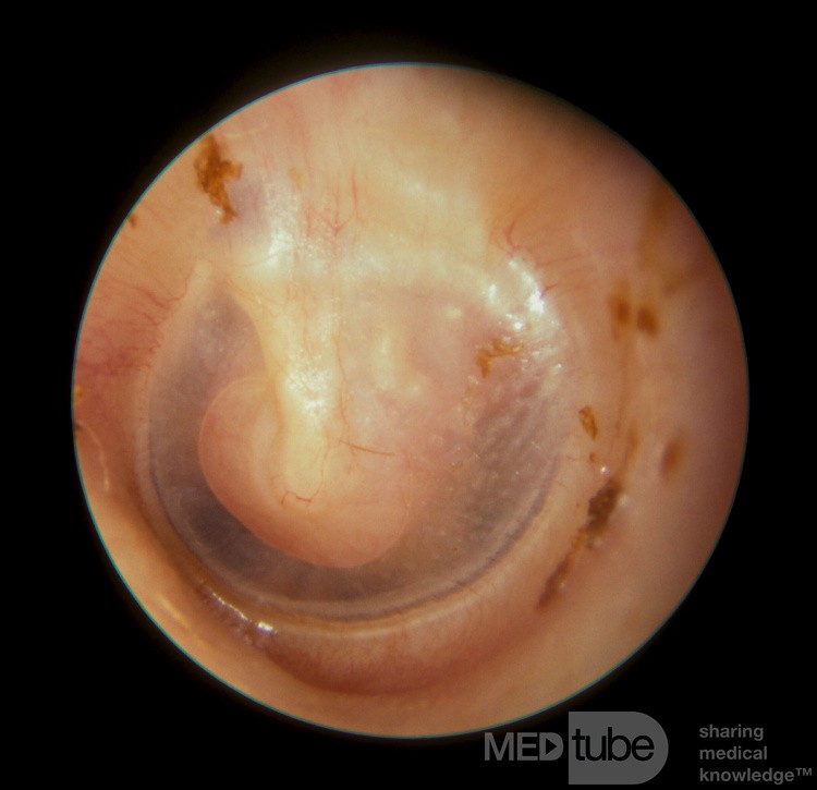 Facial Nerve Neuroma Middle Ear
