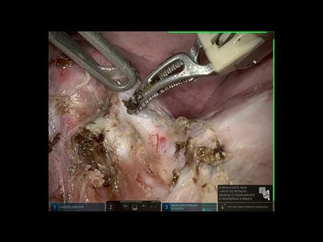 Single Metastase at Left Upper Lobe of the Lung