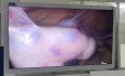 Pelvic Pain with Giant Hydrosalpinx Adherence to the Abdominal Wall