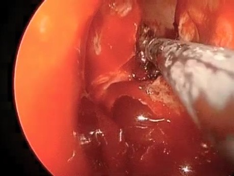 Leak of Cerebrospinal Fluid through Left Supraorbital Ethmoid Sinus and Repair of Defect