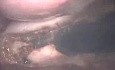Total Laparoscopic Hysterectomy