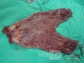 Gastric Ulcerated Adenocarcinoma of the Pre-pyloric Antrum (22 of 28)
