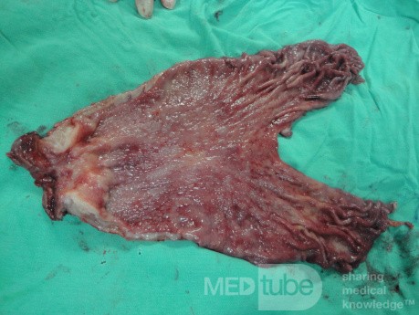 Gastric Ulcerated Adenocarcinoma of the Pre-pyloric Antrum (22 of 28)