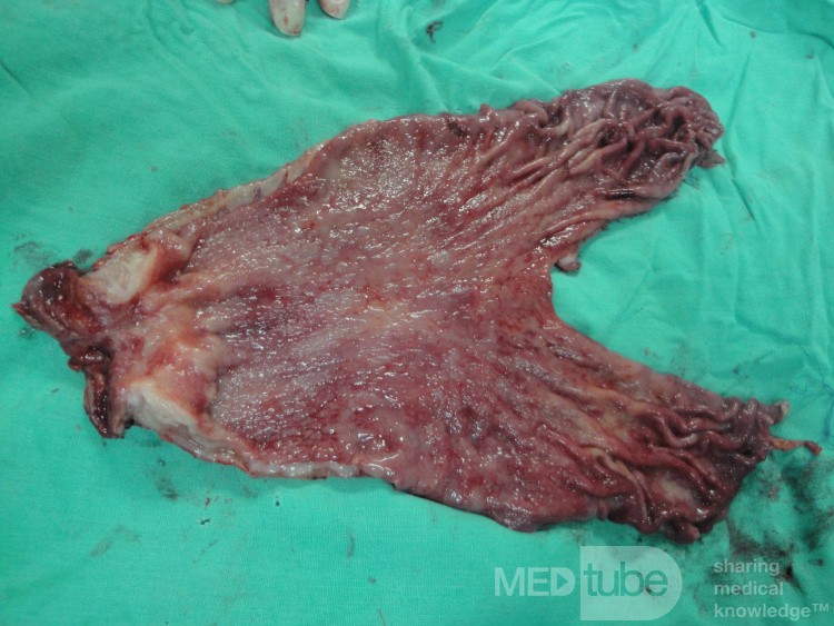 Gastric Ulcerated Adenocarcinoma of the Pre-pyloric Antrum (22 of 28)
